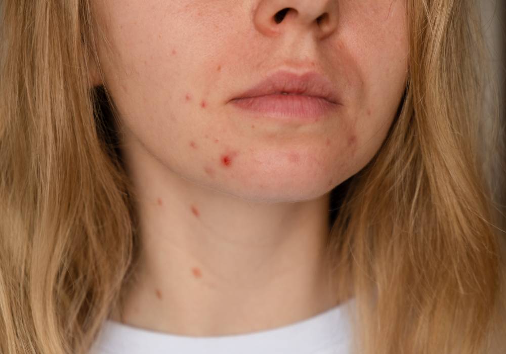 Enrojecimiento e inflamación en la piel. ¿Cómo controlar estos síntomas?
